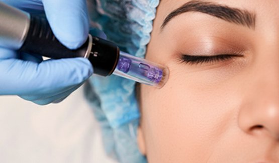 Collagen-Boosting-Laser-result